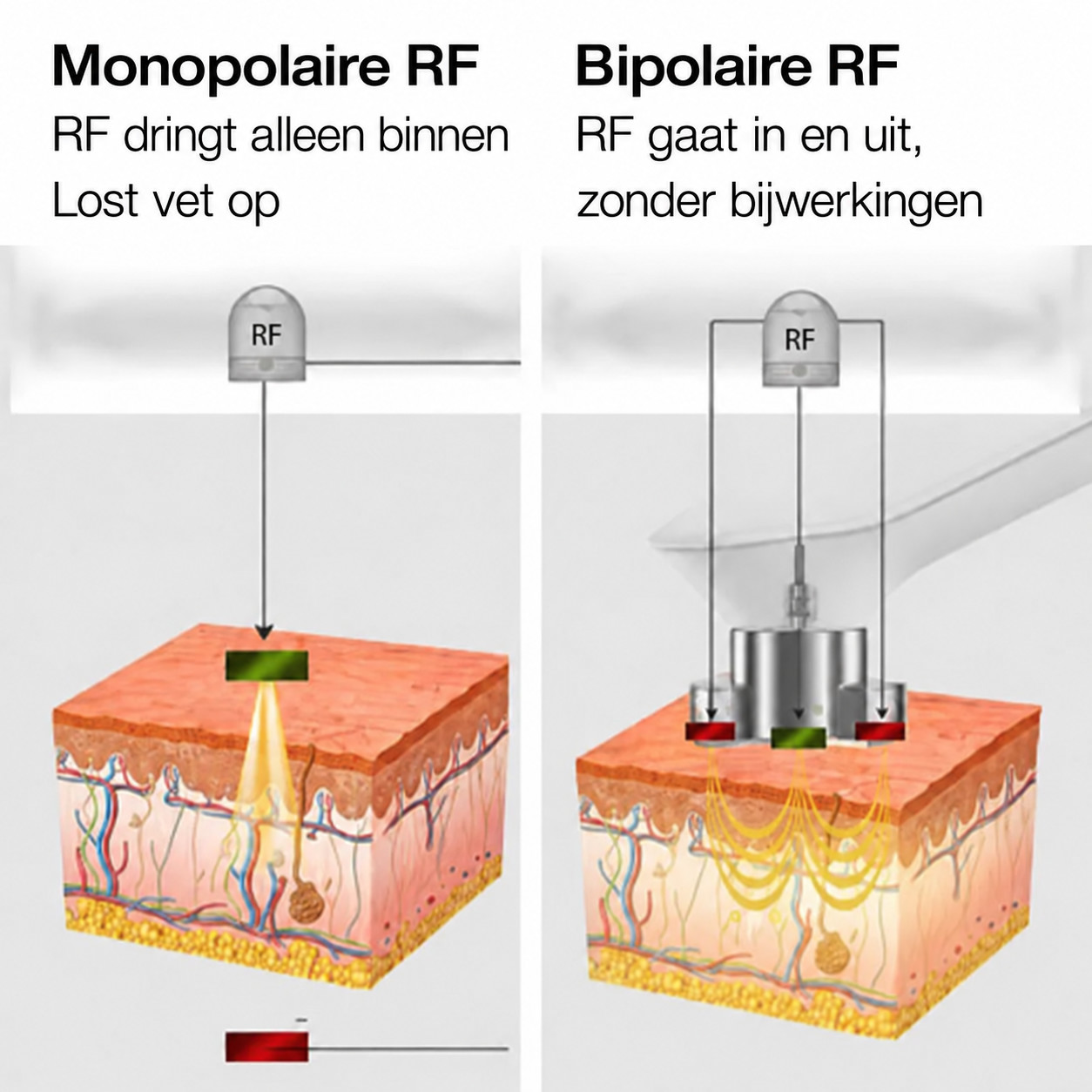 Bipolaire RF-technologie
